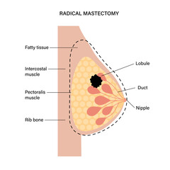 Wall Mural - Breast disease concept