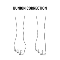 Hallux valgus, bunion correction