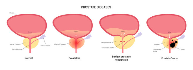 Wall Mural - Prostate cancer concept