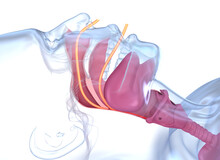 Sleep Apnea Syndrome. Labeled Nasal Tongue Blocked Airway, 3D Animation
