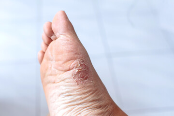 close up of an athlete foot infection on a person