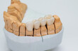 © uflypro - Metal ceramic bridge on a plaster model isolated on white background. Zirconium crowns veneers. Ceramic teeth with the veneers