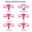 © Gegambar - Common causes of female infertility vector illustration