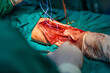 Radial free flap microvascular surgery