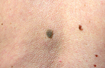 close up the black spot on human back skin. Melanoma  is a type of skin cancer develops on human skin from the pigment-producing cells melanocytes. Risk to be skin cancer.