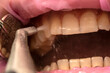 teeth sandblasting, tartar cleaning and whitening