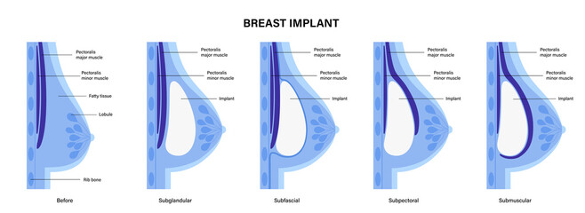 Poster - Breast Implant Concept