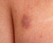 © studybos - hematoma on the skin as a background