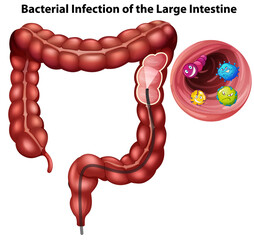 Wall Mural - Bacterial Infection of the Large Intestine