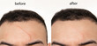 Comparison of Before and after scar revision (treatment ) using laser , led and creams on a man's forehead (face)