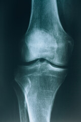 X-ray of the knee joint. Knee bone injury