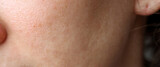 Female face with problem skin. Peeling during cold weather, acne and rashes. Problem skin of the face.