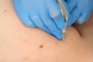 Wall Mural - Surgeon removing many small moles using laser on man's body, burning skin, closeup view. One day surgery concept. Removing papilloma or birthmark, surgical procedure.