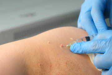 Wall Mural - Surgeon in gloves gives injection of local anesthesia to patient before laser removing moles or papillomas, closeup view. One day surgery concept. Removing nevus or birthmark. Cosmetic treatment.