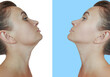 © tanya78 - woman double chin before and after treatment