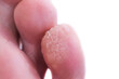 A case of verruca or plantar warts on the bottom of the small toe.  A close photo of a wart. Warts require treatment. 