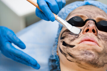 Dermatologist smears black mask on face for laser photorejuvenation and carbon peeling. Dermatology and cosmetology. Using surgical laser.