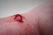 Macro of a finger with a drop of blood. Bleeding blood from the cut finger wound. Injured finger with bleeding open cut