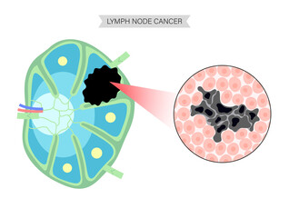 Canvas Print - Lymphoma cancer concept