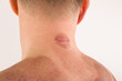 © Eskymaks - Cupping therapy marks on handsome man's back.