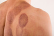 © Eskymaks - Cupping therapy marks on handsome man's back.