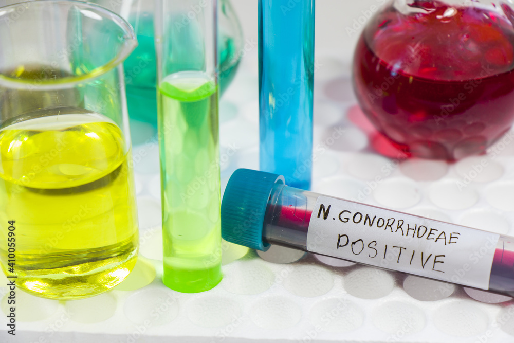Postive Labratory Test Positive N.Gonorrhoeae blood specimen on test tube with colorful ...