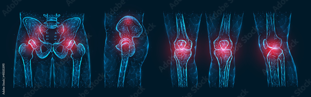 Polygonal vector illustration of pain or inflammation of the bones in the pelvis, hip joint, and knee joints isolated on a dark blue background. Orthopedic diseases medical template. - obrazy, fototapety, plakaty 