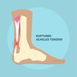 Achilles tendon rupture injury Feet calf test range of motion slight ache problem limb Thompson Simmonds