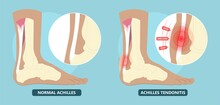 Achilles Tendon Rupture Injury Feet Calf Test Range Of Motion Slight Ache Problem Limb Thompson Simmonds