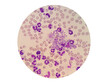 Platelets, also called thrombocytes clumps in a blood smear of dog. Platelet clumping is often caused by the anticoagulant EDTA.