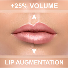 Wall Mural - Comparison of female lips after augmentation