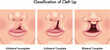 Medical illustration shows a classification of cleft lip, with annotations.