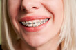 Close up of smiling patient showing white straight teeth with orthodontic brackets. Woman demonstrating results of dental braces treatment. Concept of dentistry, dental care, orthodontic treatment.