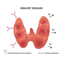 Illustration Of The Graves Disease Causes. Vector Scheme Showing Antibodies Binding To The Inflamed Thyroid Causing Thyroid To Emmit Hormones