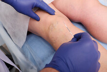 Endovasal Laser Coagulation-the Surgeon Removes Varicose Veins With A Laser.