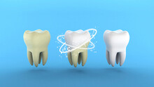 Teeth Whitening. Tooth With Tartar And After Ray Whitening. Blue Background. 3d Render