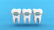 Teeth braces. Teeth alignment. Three white teeth with braces on a blue background. 3d render