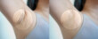 Asian woman with underarm chicken skin problem, Fox Fordyce, black armpit in woman. before and after skincare cosmetology armpits epilation treatment concept. 