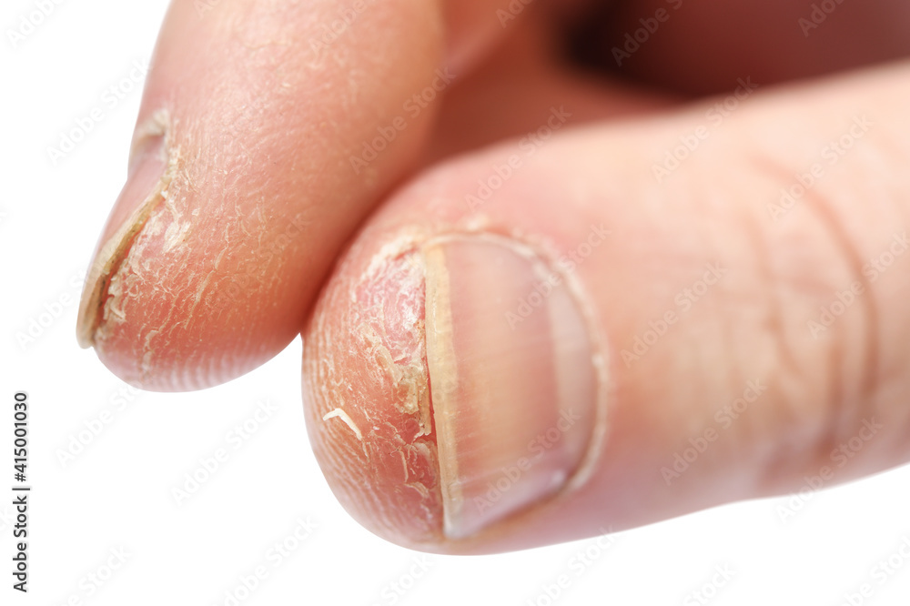 atopic dermatitis on fingers pikkelysömör mit kell kezelni