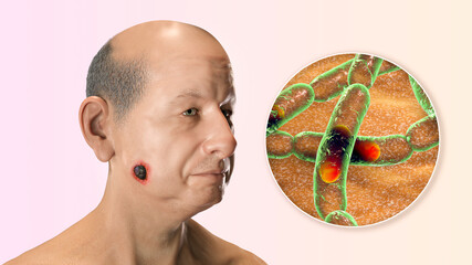 Poster - Cutaneous anthrax, the most common form of anthrax