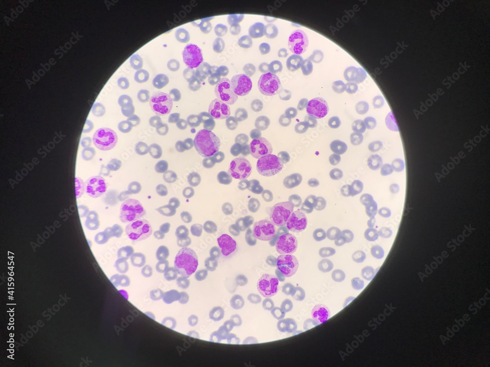 Immature and mature white blood cells.Segmented neutrophil,blast cells ...
