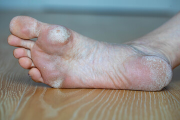 Canvas Print - Image for medical purposes. Dry skin, plantar callosity and flakes on the female feet sole close up.