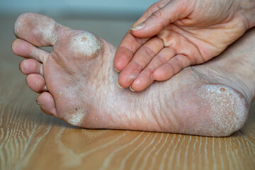 Wall Mural - Image for medical purposes. Dry skin, plantar callosity and flakes on the female feet sole close up. Hand applying medicated ointment to heel