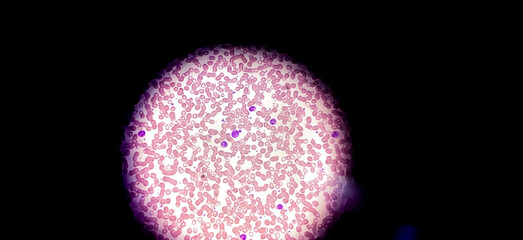 Sticker - Microscopic view of hematology slide. RBC. WBC. closeup. Stained slide. Smear. Platelet, blood film