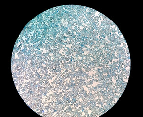 Wall Mural - Reticulocyte count from blood smear (methylene blue staining). microscopic close view. hematology