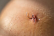 © Михаил Решетников - Close-up of a surgical suture after laparoscopic meniscus surgery.