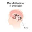 © maniki - Medulloblastoma in childhood. Brain cancer, tumor with explanations.