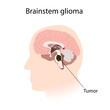 © maniki - Brainstem glioma. Brain cancer, tumor with explanations.