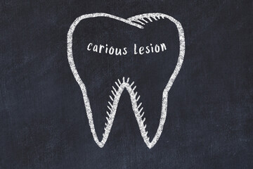 Wall Mural - Chalk drawing of a tooth with medical term carious lesion. Concept of learning stomatology