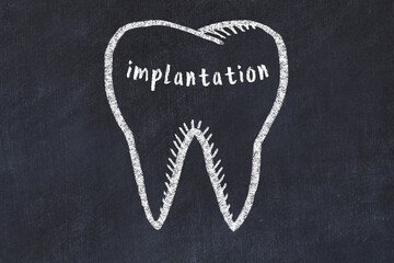 Wall Mural - Chalk drawing of a tooth with medical term implantation. Concept of learning stomatology
